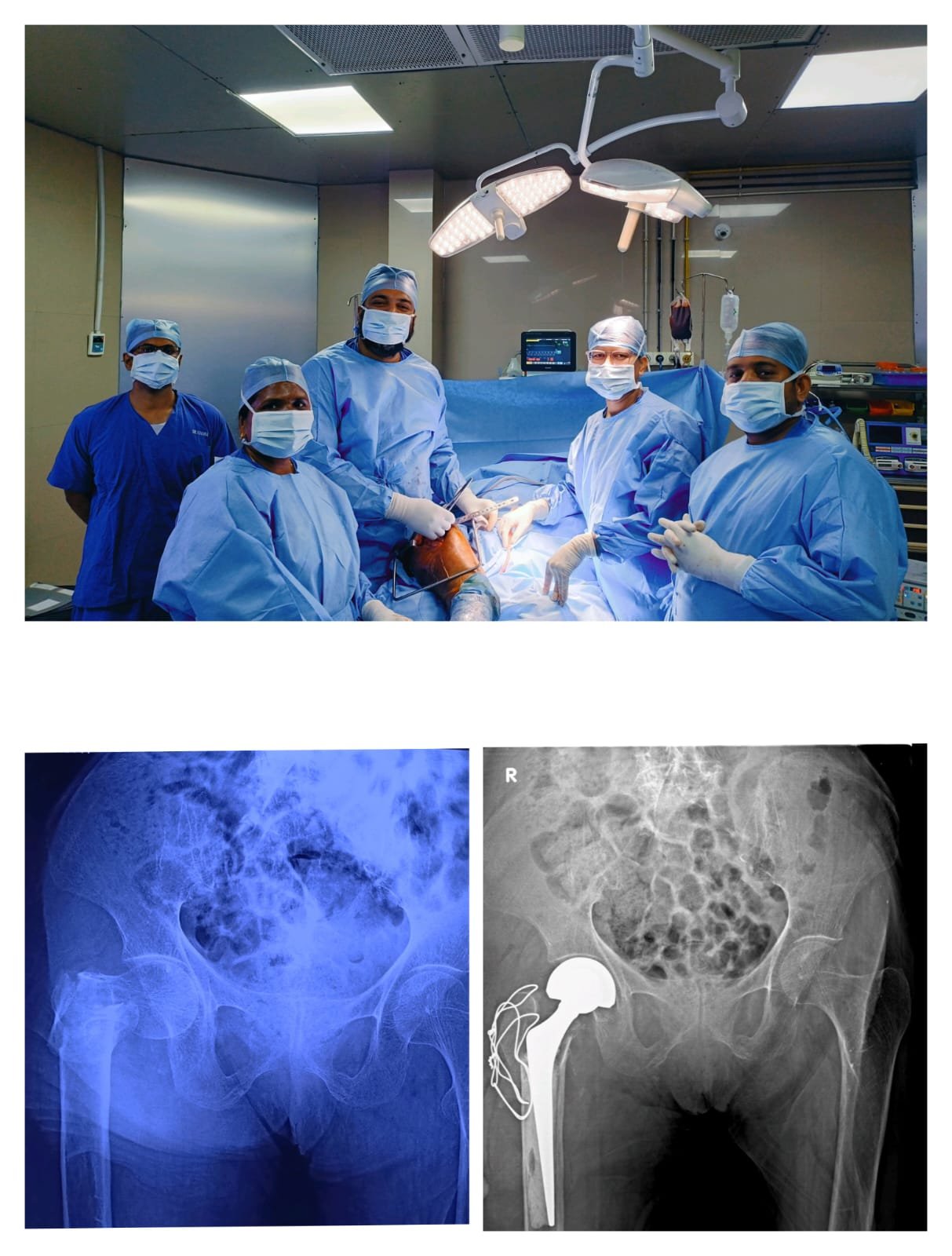 Hip Fracture in a 95 year old patient. Bipolar hip replacement with greater Trochanter Reconstruction