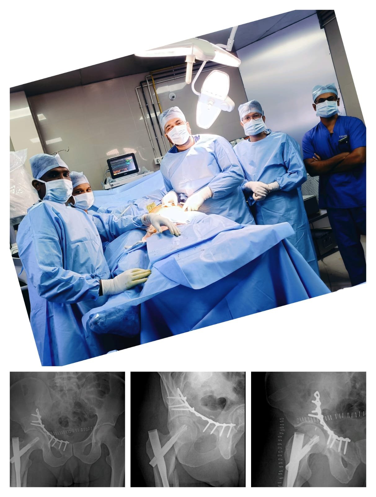 Complex Hip and Acetubular Trauma