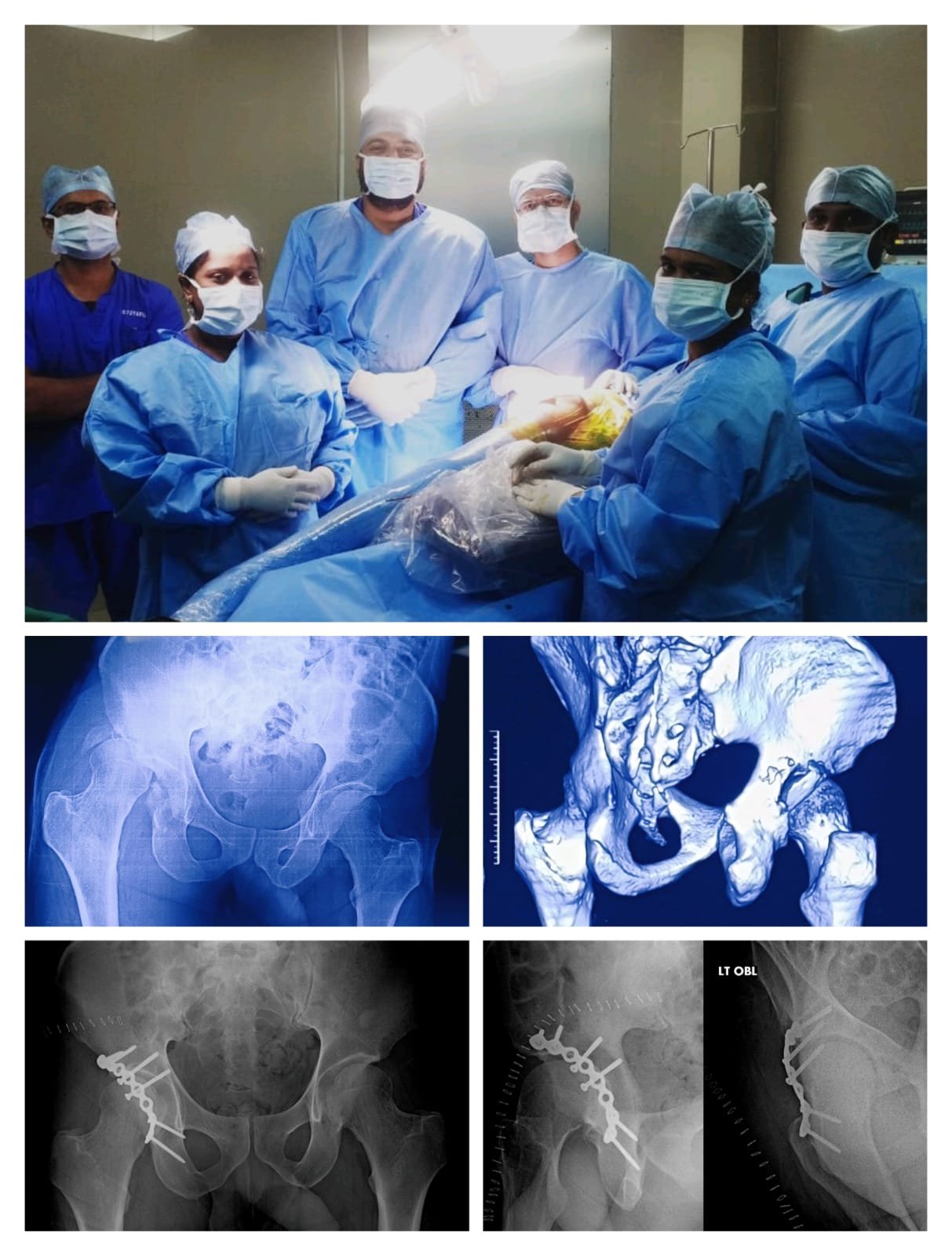 Hip dislocation with Acetabulum fracture reconstruction