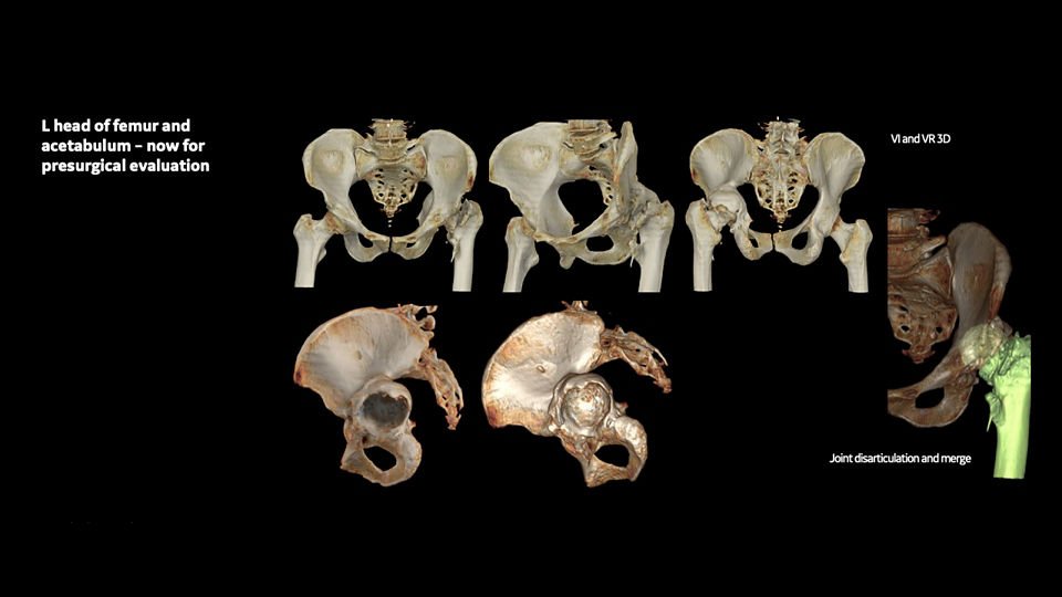 ge-revolution-aspire-boney-pelvis-image29