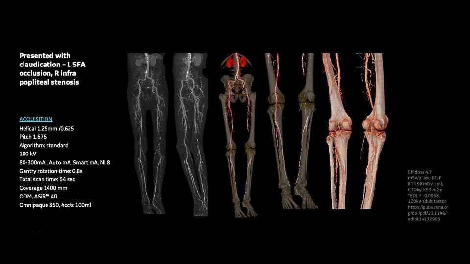 ge-revolution-aspire-lower-limb-angio-image26