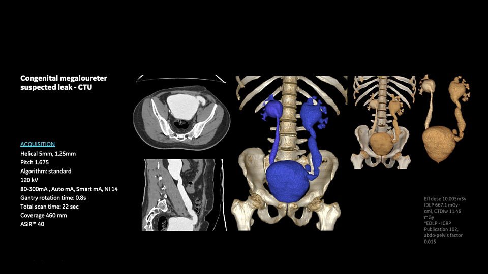ge-revolution-aspire-post-op-follow-up-image25-1