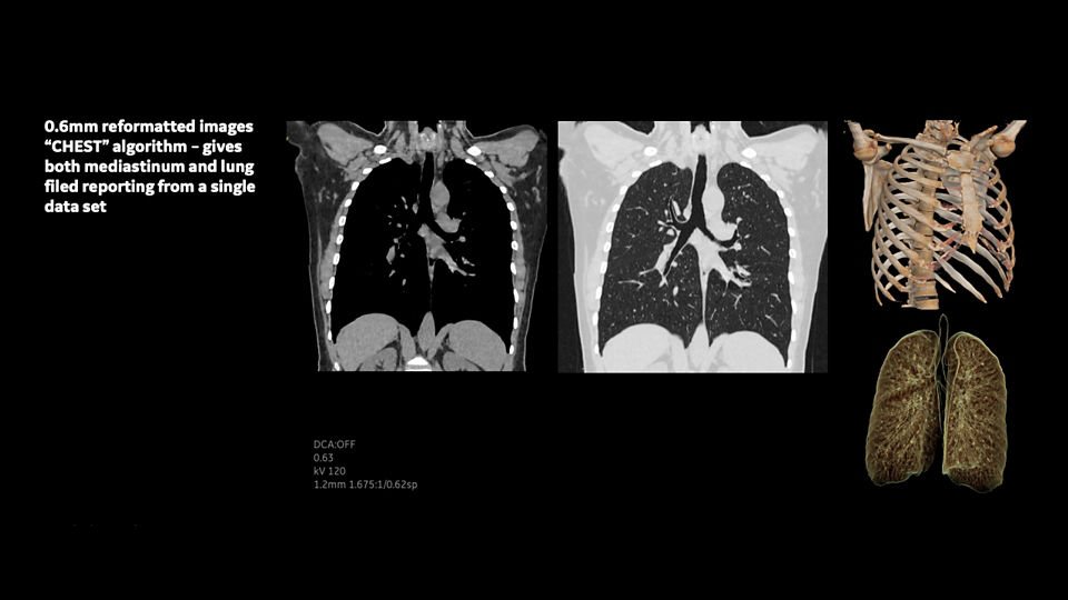 ge-revolution-aspire-routine-chest-image11